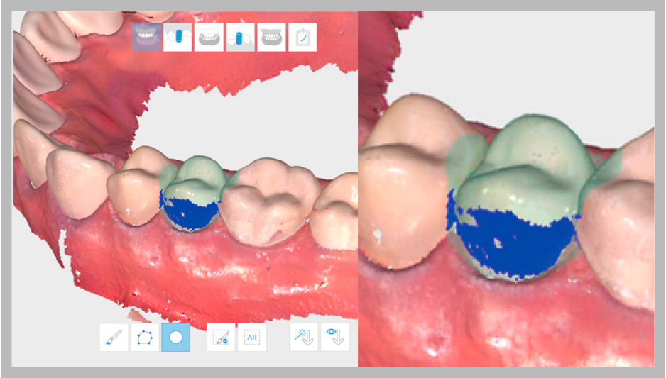 Medit Link Undercut Area Analysis
